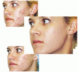 acne-lycogel